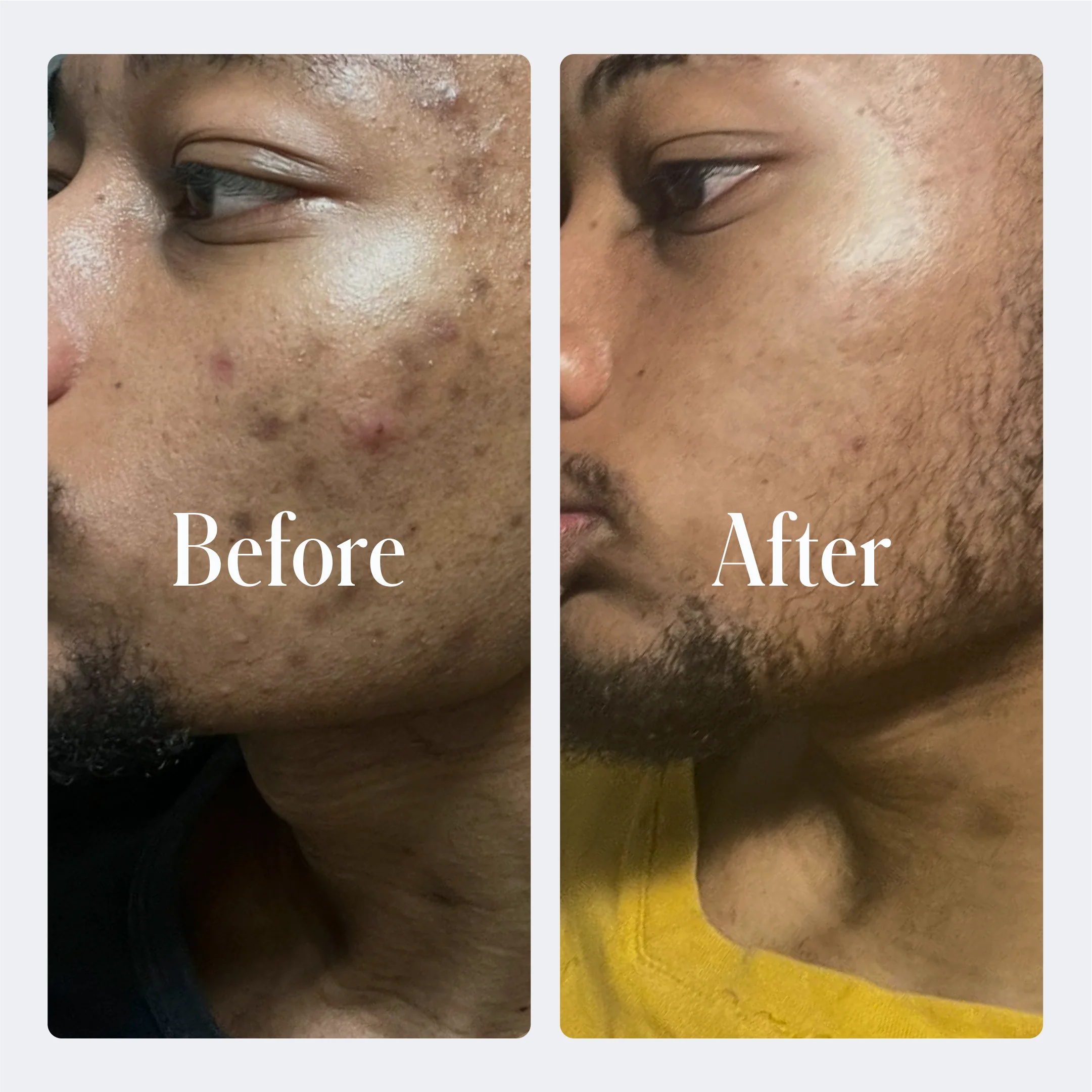 Geologie Acne Starter Kit - Image 3